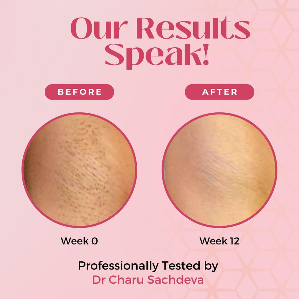 IPL Hair Removal Device