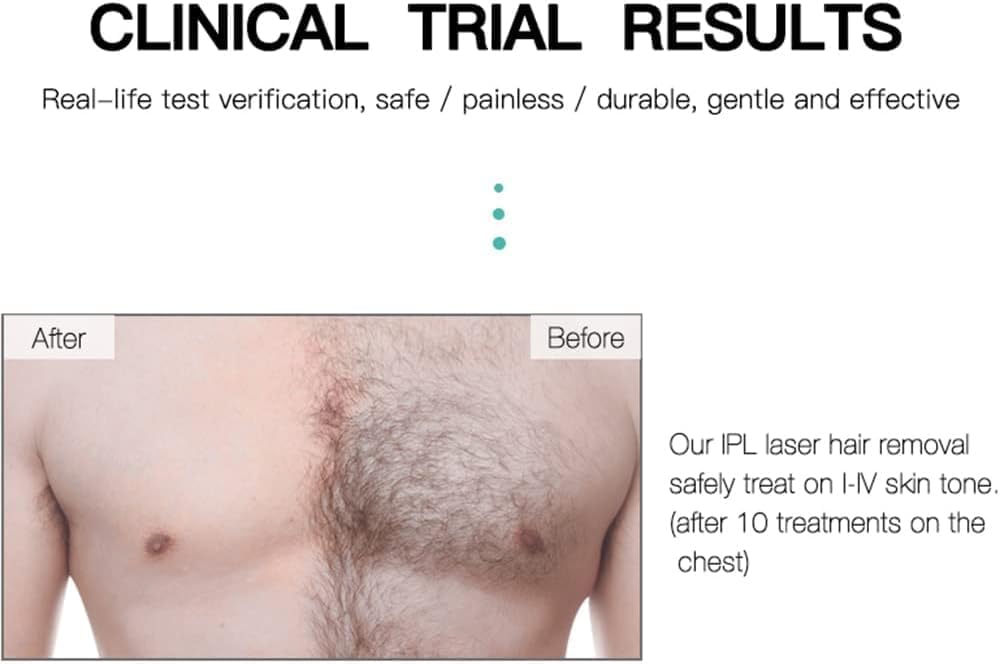 IPL Hair Removal Device